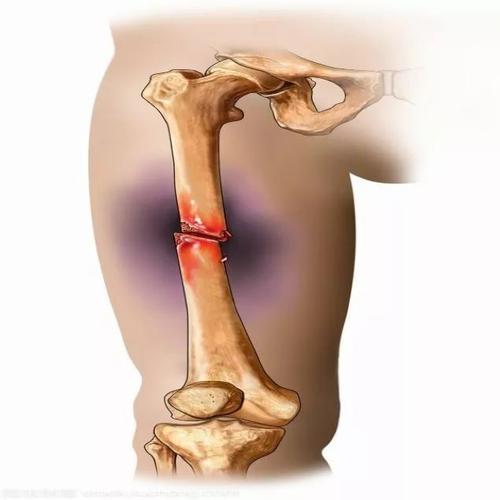 创伤性骨折科普知识文章-{下拉词